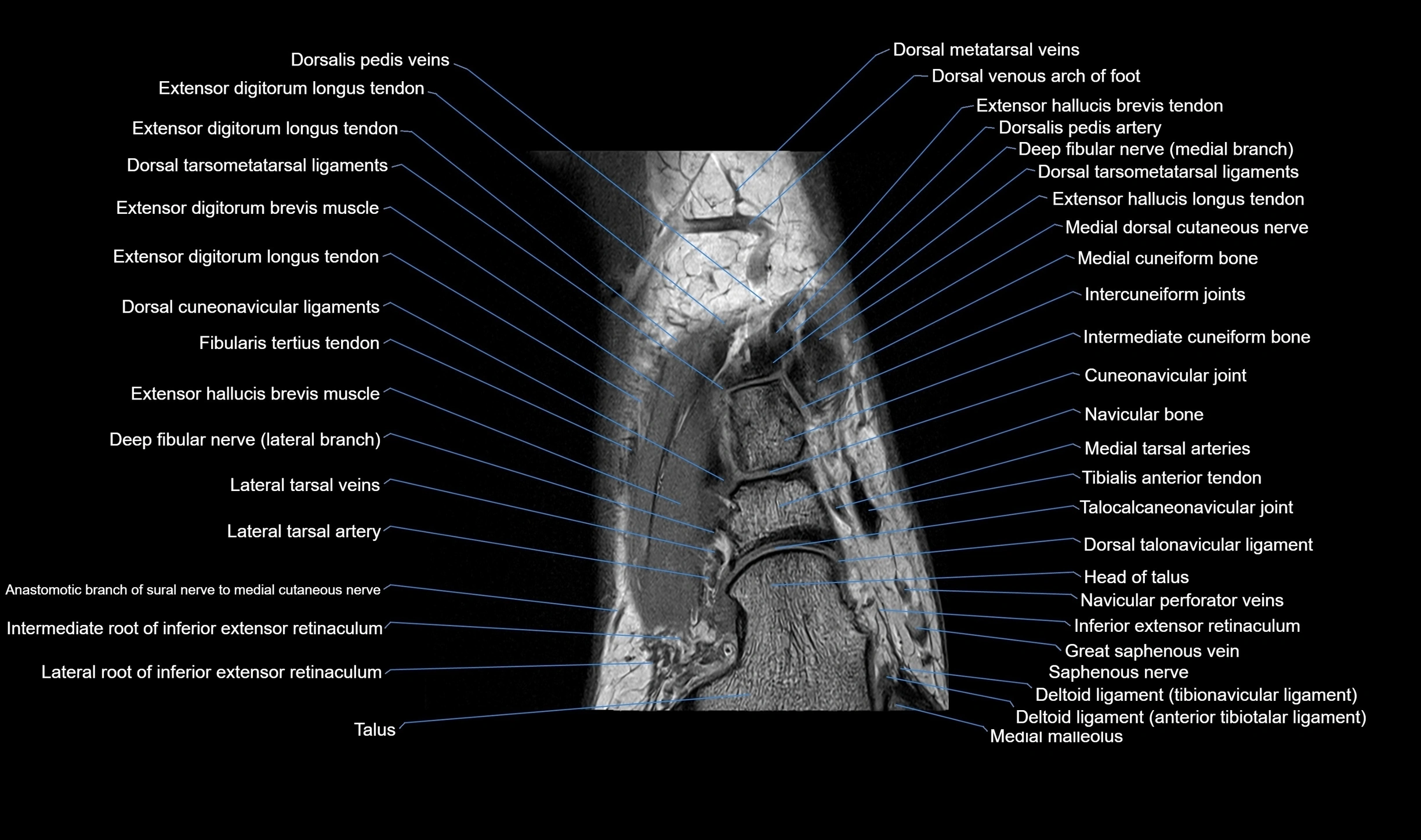 MRI mid foot coronal ligaments cross sectional anatomy 3T  radiology  image-img-00001-00013.webp